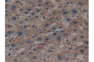 Detection of SHH in Human Liver cancer Tissue using Polyclonal Antibody to Hedgehog Homolog, Sonic (SHH) (Sonic Hedgehog 抗体  (AA 36-193))
