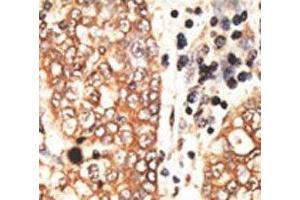IHC analysis of FFPE human hepatocarcinoma tissue stained with the NRG2 antibody (Neuregulin 2 抗体  (AA 830-855))