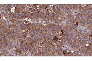 ABIN6273702 at 1/100 staining Human liver cancer tissue by IHC-P. (Cyclin M3 抗体  (Internal Region))