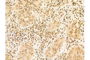 ABIN6265927 and ABIN6273024 at 1/100 staining Human lung cancer by IHC-P. (USP39 抗体  (N-Term))