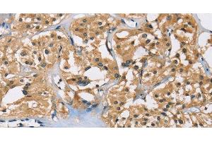 Immunohistochemistry of paraffin-embedded Human thyroid cancer using PPP3CA Polyclonal Antibody at dilution of 1:40 (PPP3CA 抗体)