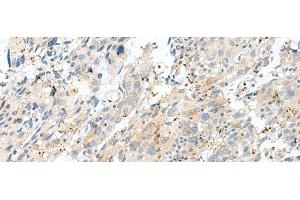 Immunohistochemistry of paraffin-embedded Human cervical cancer tissue using NXNL1 Polyclonal Antibody at dilution of 1:45(x200) (NXNL1 抗体)