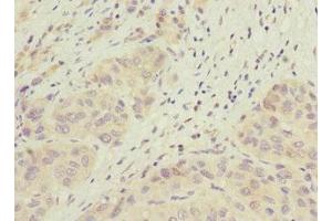 Immunohistochemistry of paraffin-embedded human liver cancer using ABIN7165663 at dilution of 1:100 (PHF17 抗体  (AA 543-842))