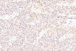 Immunohistochemistry analysis of paraffin-embedded human liver cancer using SRFBP1 (ABIN7075579) at dilution of 1: 2000 (SRFBP1 抗体)