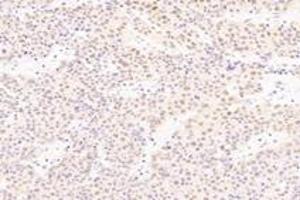 Immunohistochemistry analysis of paraffin-embedded human liver cancer using SRFBP1 (ABIN7075579) at dilution of 1: 2000