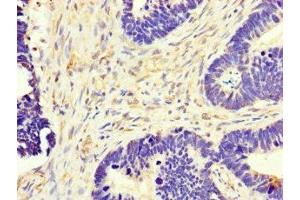 Immunohistochemistry of paraffin-embedded human ovarian cancer using ABIN7149154 at dilution of 1:100 (COX1 抗体  (AA 474-513))