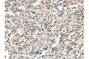 The image on the left is immunohistochemistry of paraffin-embedded Human liver cancer tissue using ABIN7128031(THAP2 Antibody) at dilution 1/20, on the right is treated with fusion protein. (THAP2 抗体)