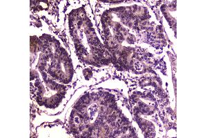 Immunohistochemistry (IHC) image for anti-SWI/SNF Related, Matrix Associated, Actin Dependent Regulator of Chromatin, Subfamily A, Member 4 (SMARCA4) (AA 555-763) antibody (ABIN5692863)