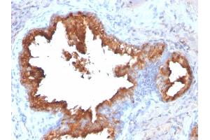 Formalin-fixed, paraffin-embedded human Prostate Carcinoma stained with PSA Rabbit Recombinant Monoclonal Antibody (KLK3/2871R). (Recombinant Prostate Specific Antigen 抗体)