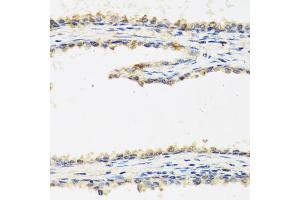 Immunohistochemistry of paraffin-embedded human prostate using SPINT1 antibody (ABIN5973812) at dilution of 1/100 (40x lens). (SPINT1 抗体)