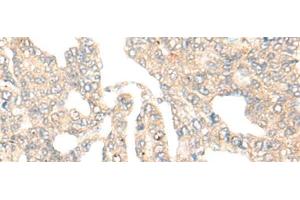 Immunohistochemistry of paraffin-embedded Human liver cancer tissue using DCP2 Polyclonal Antibody at dilution of 1:45(x200) (DCP2 抗体)