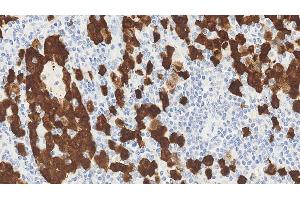 Anaplastic large cell lymphoma: immunohistochemical staining for ALK. (P80 (C-Term), (Catalytic Domain) 抗体)