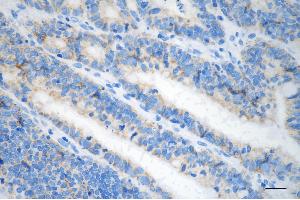Immunohistochemistry was performed on paraffin-embedded human sigmoid colon carcinoma using CLPX antibody (ABIN7798101), 1:200). (Recombinant CLPX 抗体)