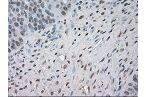 Immunohistochemical staining of paraffin-embedded Adenocarcinoma of colon tissue using anti-NAT8mouse monoclonal antibody. (NAT8 抗体)