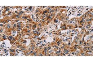 Immunohistochemistry of paraffin-embedded Human lung cancer using MMP1 Polyclonal Antibody at dilution of 1:60 (MMP1 抗体)