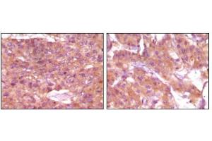 Immunohistochemical analysis of paraffin-embedded human skin carcinoma (left) and breast carcinoma (right), showing cytoplasmic and membrane localization using SRA mouse mAb with DAB staining. (SRA1 抗体)