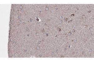 ABIN6276691 at 1/100 staining Human brain cancer tissue by IHC-P. (TLR8 抗体  (C-Term))