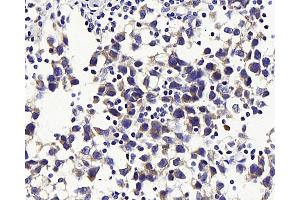 Immunohistochemistry analysis of paraffin-embedded human testis cancer using GLUT-3 Polyclonal Antibody at dilution of 1:300. (SLC2A3 抗体)