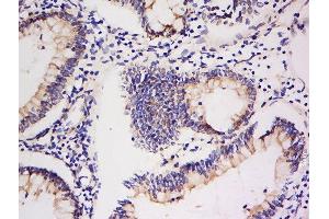 Formalin-fixed and paraffin embedded human colon carcinoma labeled with Anti-Integrin Alpha V + Beta 5 Polyclonal Antibody, Unconjugated  at 1:200 followed by conjugation to the secondary antibody and DAB staining. (ITGAV/ITGB5 抗体)