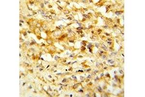 IHC analysis of FFPE human prostate carcinoma stained with NKX3.
