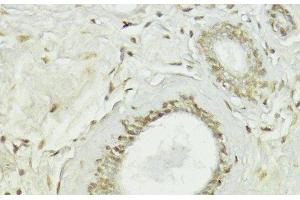 Immunohistochemistry of paraffin-embedded Human breast using Snail Polyclonal Antibody at dilution of 1:100 (40x lens). (SNAIL 抗体)