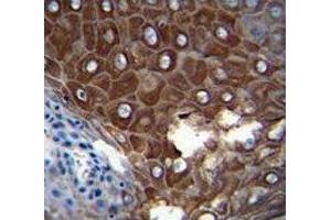 MMP1 antibody immunohistochemistry analysis in formalin fixed and paraffin embedded human esophageal carcinoma (MMP1 抗体  (AA 317-347))