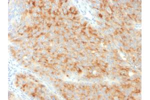 Formalin-fixed, paraffin-embedded human Pancreatic Carcinoma stained with Synaptophysin-Monospecific Mouse Monoclonal Antibody (SYP/3551). (MSH2 抗体  (AA 224-313))