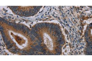 Immunohistochemistry of paraffin-embedded Human colon cancer using MAP3K11 Polyclonal Antibody at dilution of 1:40 (MAP3K11 抗体)