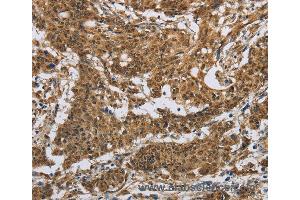 Immunohistochemistry of Human gastric cancer using IL5RA Polyclonal Antibody at dilution of 1:40 (IL5RA 抗体)