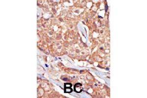 Formalin-fixed and paraffin-embedded human cancer tissue reacted with TRPM6 polyclonal antibody  , which was peroxidase-conjugated to the secondary antibody, followed by AEC staining. (TRPM6 抗体  (Internal Region))