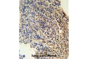 ZNF197 antibody (N-term) immunohistochemistry analysis in formalin fixed and paraffin embedded human lung carcinoma followed by peroxidase conjugation of the secondary antibody and DAB staining. (ZNF197 抗体  (N-Term))