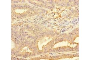 Immunohistochemistry of paraffin-embedded human endometrial cancer using ABIN7158455 at dilution of 1:100 (PPFIA1 抗体  (AA 660-800))
