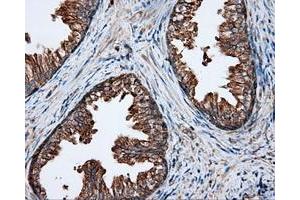 Immunohistochemical staining of paraffin-embedded Adenocarcinoma of ovary tissue using anti-RC201933 mouse monoclonal antibody. (PIM2 抗体)