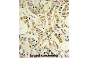 RPS13 Antibody IHC analysis in formalin fixed and paraffin embedded breast carcinoma followed by peroxidase conjugation of the secondary antibody and DAB staining. (RPS13 抗体  (AA 82-110))