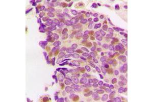 Immunohistochemical analysis of PS1D staining in human breast cancer formalin fixed paraffin embedded tissue section. (ZCCHC17 抗体  (Center))