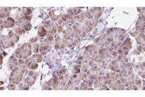 ABIN6273224 at 1/100 staining Human pancreas cancer tissue by IHC-P. (DAAM1 抗体  (Internal Region))