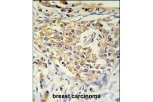 ADFP Antibody (Center) (ABIN651311 and ABIN2840181) IHC analysis in formalin fixed and paraffin embedded breast carcinoma followed by peroxidase conjugation of the secondary antibody and DAB staining. (ADRP 抗体  (AA 186-214))