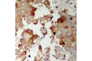 Immunohistochemical analysis of MRPS17 staining in human prostate cancer formalin fixed paraffin embedded tissue section. (MRPS17 抗体  (N-Term))