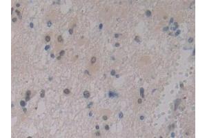 Detection of IGFBP1 in Human Glioma Tissue using Polyclonal Antibody to Insulin Like Growth Factor Binding Protein 1 (IGFBP1) (IGFBPI 抗体  (AA 36-235))
