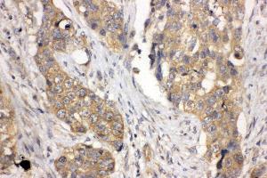 Anti-LASP1 antibody, IHC(P) IHC(P): Human Lung Cancer Tissue (LASP1 抗体  (N-Term))