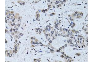 Immunohistochemistry of paraffin-embedded human liver cancer using SIN3A antibody. (SIN3A 抗体)