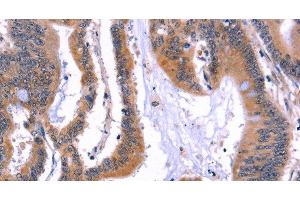 Immunohistochemistry of paraffin-embedded Human colon cancer using ARC Polyclonal Antibody at dilution of 1:50 (ARC 抗体)