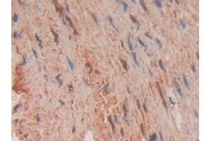 Detection of FADD in Human Stomach cancer Tissue using Polyclonal Antibody to Fas Associating Death Domain Containing Protein (FADD) (FADD 抗体  (AA 12-206))
