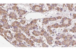 ABIN6272676 at 1/100 staining Human liver cancer tissue by IHC-P. (BAI3 抗体  (Internal Region))