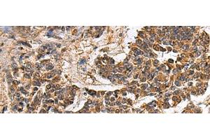 Immunohistochemistry of paraffin-embedded Human colorectal cancer tissue using GANAB Polyclonal Antibody at dilution of 1:30(x200) (GANAB 抗体)