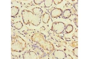 Immunohistochemistry of paraffin-embedded human gastric cancer using ABIN7145609 at dilution of 1:100 (Pallidin 抗体  (AA 1-170))
