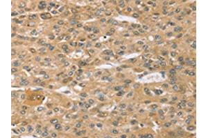 The image on the left is immunohistochemistry of paraffin-embedded Human liver cancer tissue using ABIN7192633(SPON1 Antibody) at dilution 1/30, on the right is treated with synthetic peptide. (SPON1 抗体)