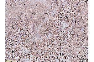 Formalin-fixed and paraffin embedded human lung carcinoma labeled with Anti-EGFR Polyclonal Antibody, Unconjugated (ABIN725720) at 1:200 followed by conjugation to the secondary antibody and DAB staining (EGFR 抗体  (AA 951-1050))