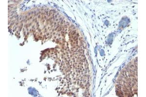 Formalin-fixed, paraffin-embedded human Bladder Carcinoma stained with Cytokeratin 6 Mouse Monoclonal Antibody (SPM269). (KRT6A/KRT6B/KRT6C (C-Term) 抗体)