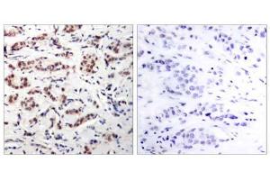 Immunohistochemical analysis of paraffin-embedded human breast carcinoma tissue using STAT5A (phospho-Tyr694) antibody (E011048). (STAT5A 抗体  (pTyr694))